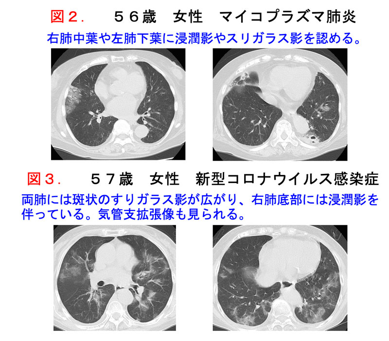 マイコプラズマ肺炎 新型コロナウイルス感染症